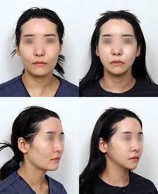 Does a Low Nerve Canal Make Square Jaw Surgery Difficult? Ways to Improve Frontal Results image 7