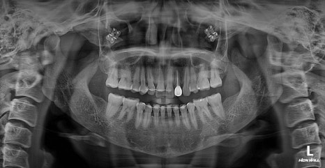 Does a Low Nerve Canal Make Square Jaw Surgery Difficult? Ways to Improve Frontal Results image 6