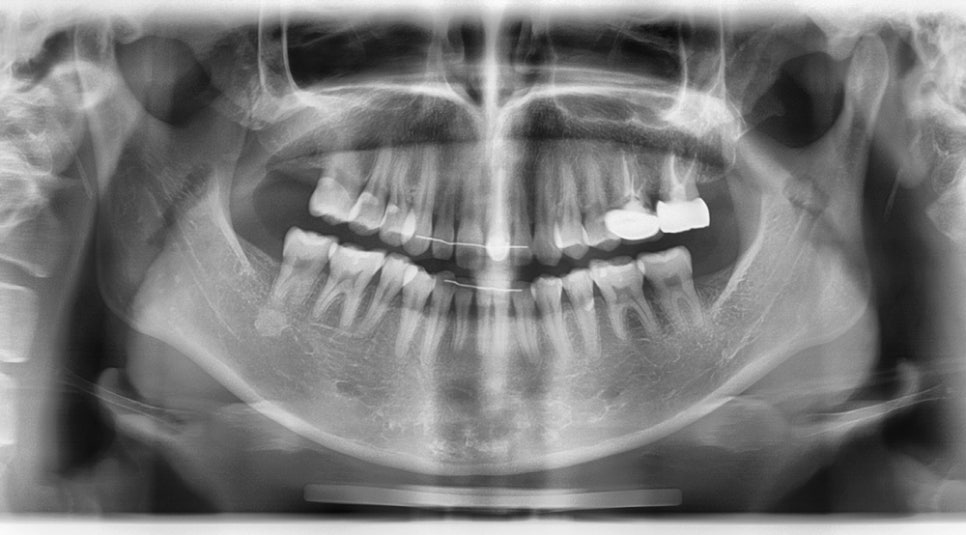 Long Midface and Lower Face Long-Face, Long-Chin Surgery - Cases That Do Not Require Double-Jaw Surgery image 4