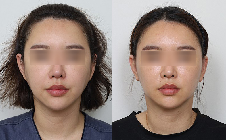뼈를 건드리지 않는 관련 이미지 2