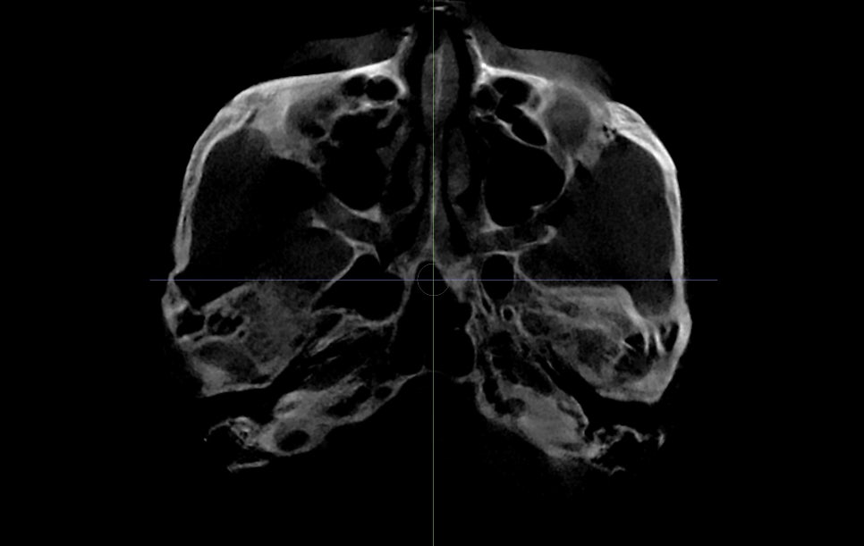 Is It Necessary to Remove the Fixation Pins After Facial Contouring Surgery? image 8