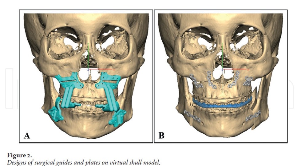 [Paper Review] Technological Advances and Real-World Applications in Modern Facial Contouring Surgery: Correction of Facial Asymmetry image 3