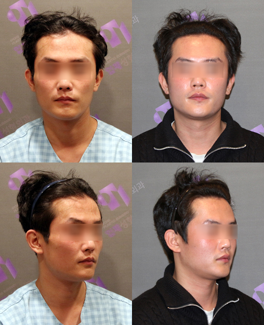 After cheekbone reduction surgery, is there still a back cheekbone left? Is there a solution? image 6