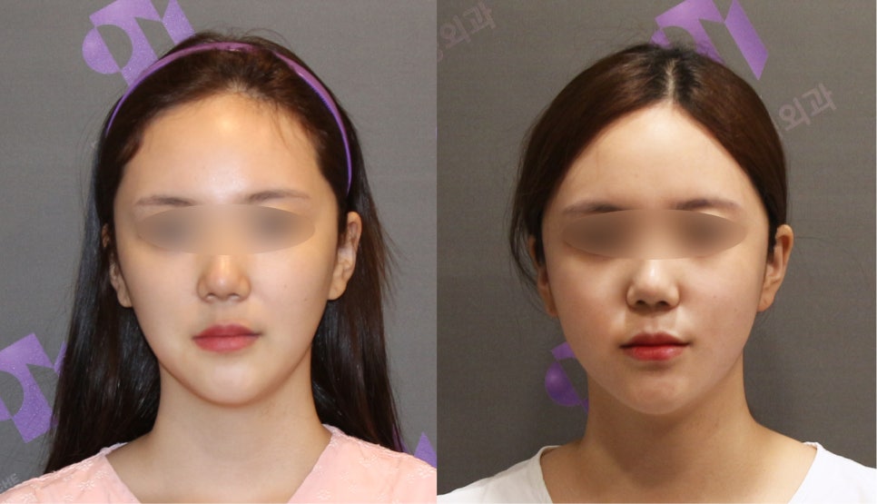 안면윤곽연예인, 연예인들은 왜 갈수록 예뻐질까요? - 성형외과 전문의가 직접알려드립니다. 관련 이미지 4