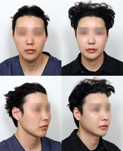 긴턱 교정은 어떤 수술이 좋을까요? 턱끝축소술의 한계와 실제 결과 관련 이미지 4