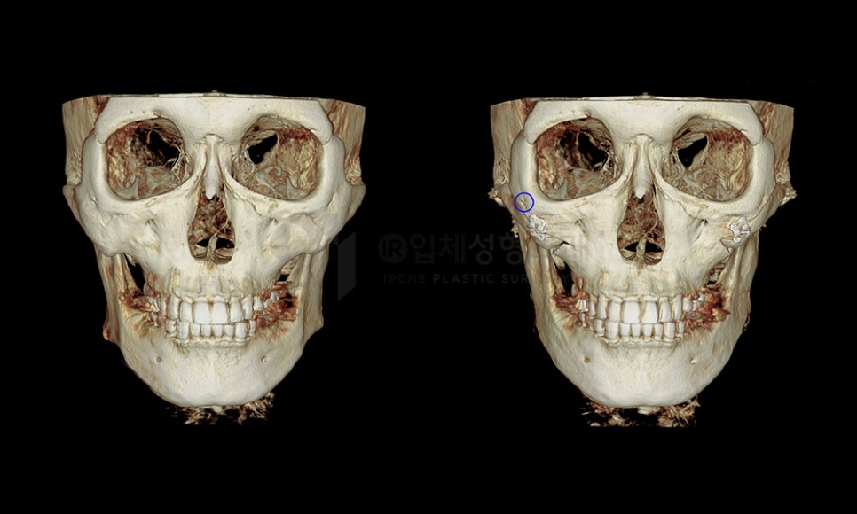 What Side Effects Can Occur Due to Excessive Bone Resection in Facial Contouring Surgery? image 2