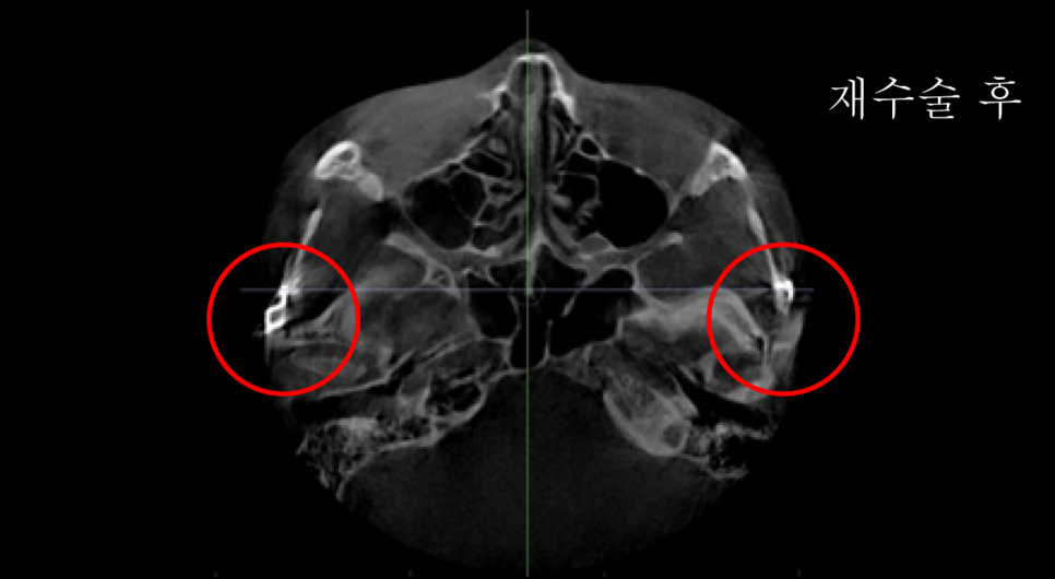 A Complete Summary of 6 Complications After Cheekbone Surgery: Sinusitis, Recurrence, Hollow Cheeks, and Sagging Cheeks image 7