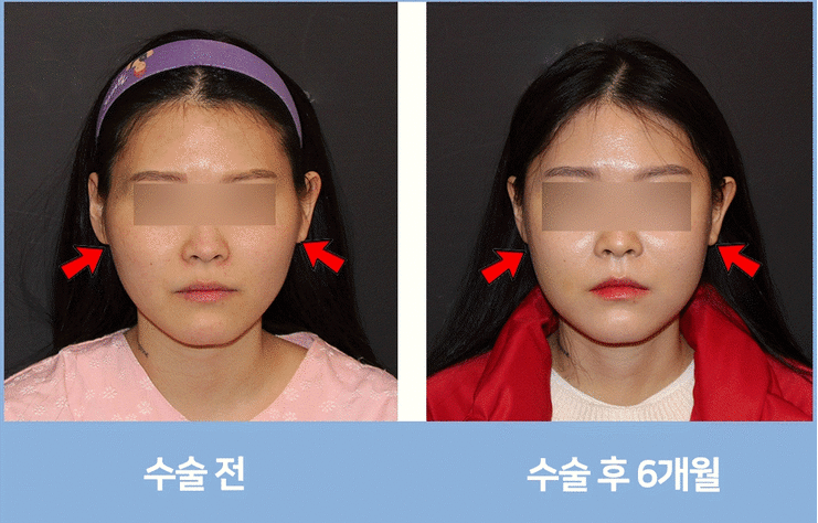 Is General Anesthesia Necessary Before Facial Contouring Surgery? image 2