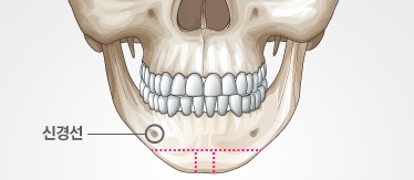 What Is Chin Surgery? image 1