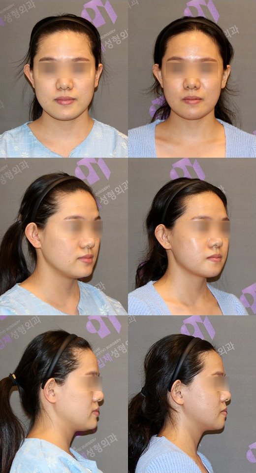 주걱턱은 어떤 수술을 해야 할까요? 관련 이미지 4
