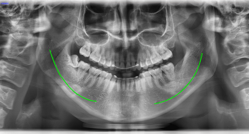 Long Chin, Long Face Contouring - Cases That Do Not Require Double Jaw Surgery image 4