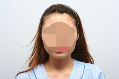 옆광대축소술 정말 효과가 없나요? 관련 이미지 1