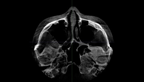 A Complete Summary of 6 Complications After Cheekbone Surgery: Sinusitis, Recurrence, Hollow Cheeks, and Sagging Cheeks image 9