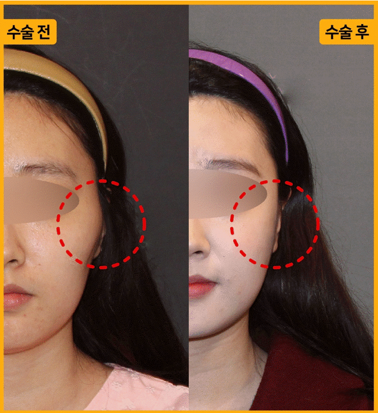 Is General Anesthesia Necessary Before Facial Contouring Surgery? image 1