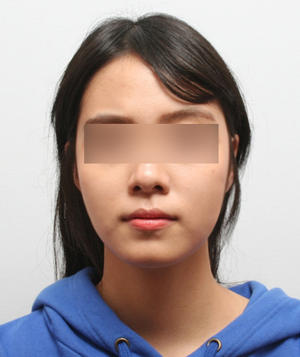 If the Face (Cheekbones) Is Asymmetrical, Can It Be Corrected with Cheekbone Reduction Surgery? image 3