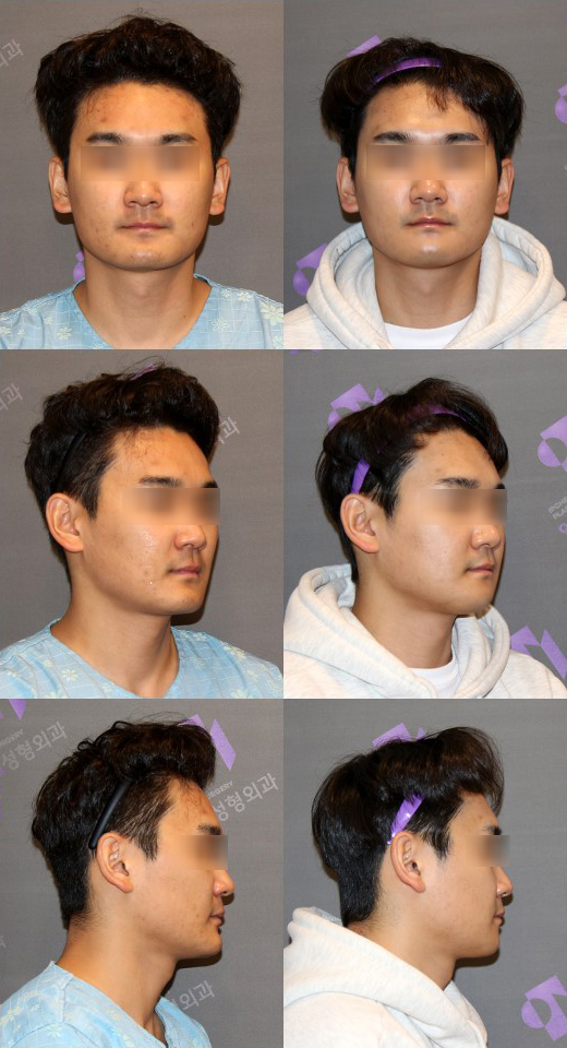 주걱턱은 어떤 수술을 해야 할까요? 관련 이미지 11
