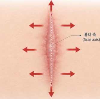 안면거상 후 흉터 관리와 주의사항 관련 이미지 3