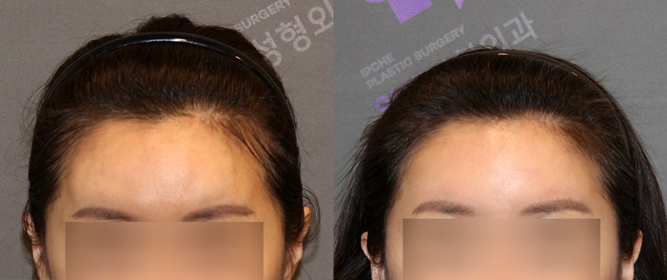 Forehead Fat Grafting Side Effects: Is There a Way to Remove Excess Fat? image 5