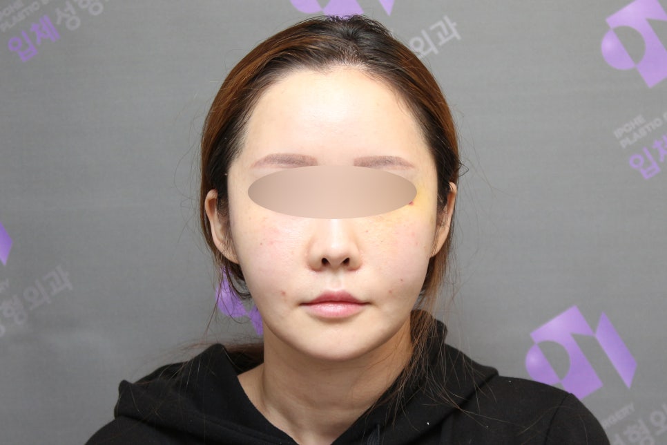 옆광대수술후기, 사례와 함께 알아보기 - 전문의가 직접알려드립니다. 관련 이미지 10