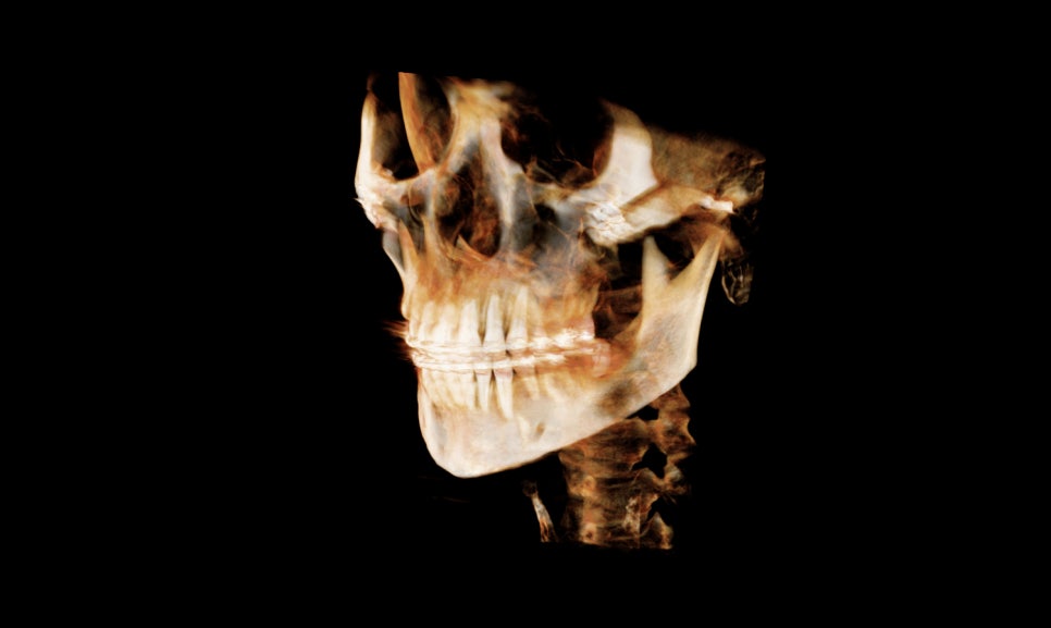 Why Are There So Many Methods for Cheekbone Surgery? A Look at Osteotomy Methods image 10