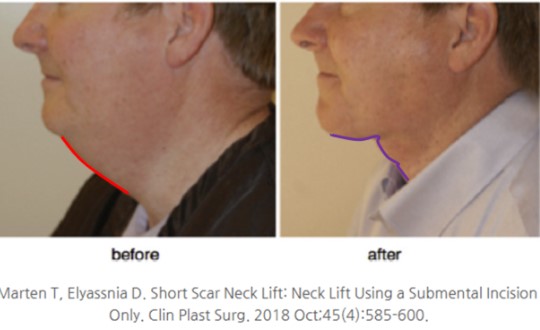 Is it possible to do a mini neck lift on its own? image 5