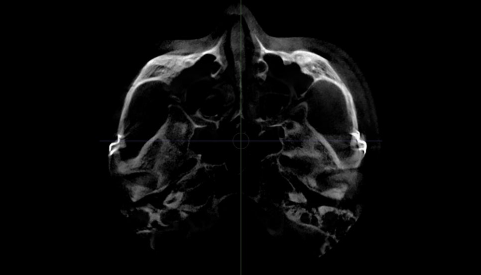 Why Is Male Cheekbone Reduction Different from Female Cheekbone Reduction? image 8
