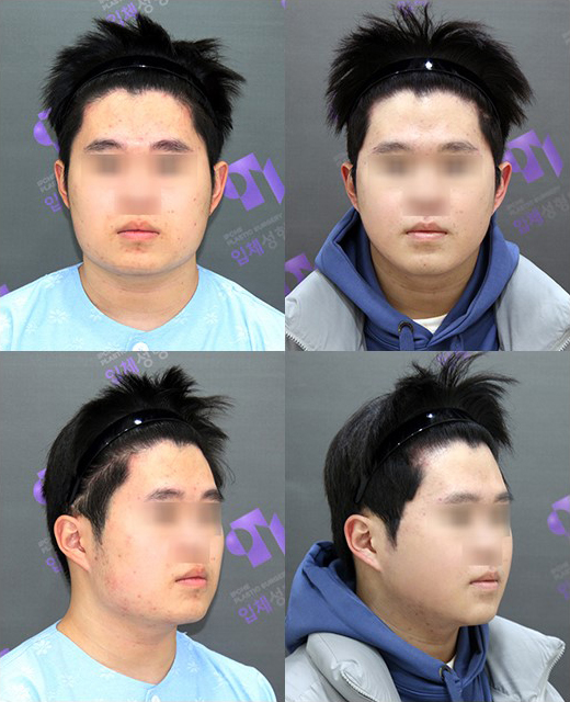 Square Jaw Surgery: The Difference Between Cortical Osteotomy and Lateral Cortical Shaving image 15