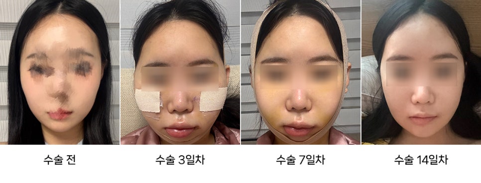 The Difference Between Swelling and Cheek Sagging After Facial Contouring Surgery image 5