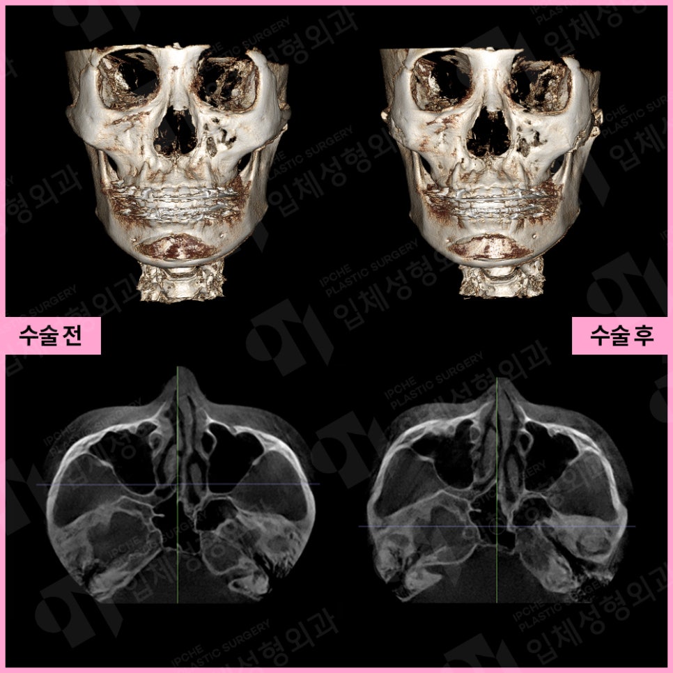 Zygoma Reduction Surgery: Quick Zygoma vs. 3D Zygoma Surgery Differences in Effect and Selection Criteria image 6