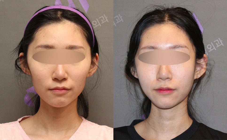 45-Degree Cheekbone Reduction Surgery Review, Let’s Look at Cases Together - Information from a Specialist image 8