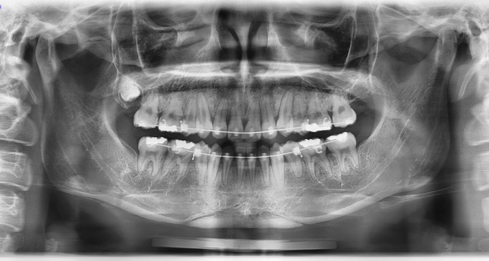 Is It Necessary to Remove the Fixation Pins After Facial Contouring Surgery? image 6