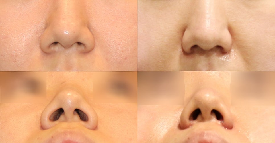 Incisional or Non-incisional? A Review of Alar Reduction Surgery Cases (Alar Base Reduction) image 4