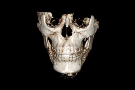 Are There People Who Can’t Have Cortical Ostectomy Surgery for a Frontal Square Jaw Effect? image 17