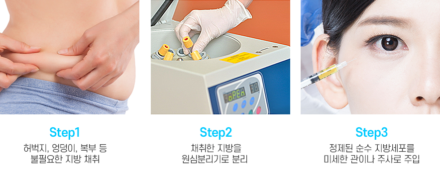 돌출눈과 함몰눈은 어떤 수술로 교정이 가능한가요? 관련 이미지 9