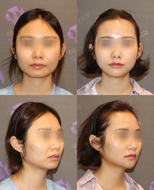 턱보조개, 갈라진턱, 엉덩이턱은 어떻게 해결해야 할까요? 관련 이미지 5