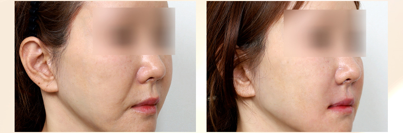 A Complete Guide to the Effects and Side Effects of the Collagen Booster Radiesse Procedure image 4