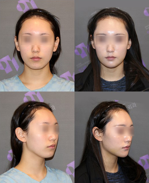 Is There a Way to Address the Secondary Angle That Appears After Chin Surgery? image 9