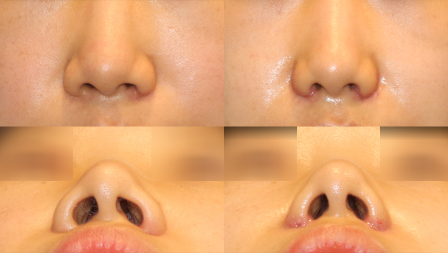 Incisional or Non-incisional? A Review of Alar Reduction Surgery Cases (Alar Base Reduction) image 3