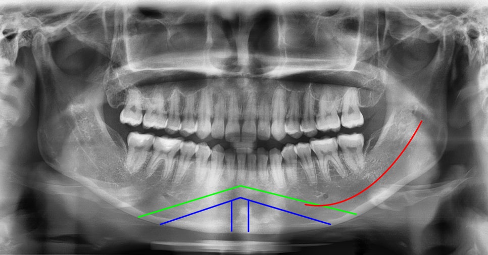 What Side Effects Can Occur Due to Excessive Reduction in Facial Contouring Surgery? image 5