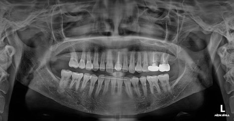 Long Midface and Lower Face Long-Face, Long-Chin Surgery - Cases That Do Not Require Double-Jaw Surgery image 6