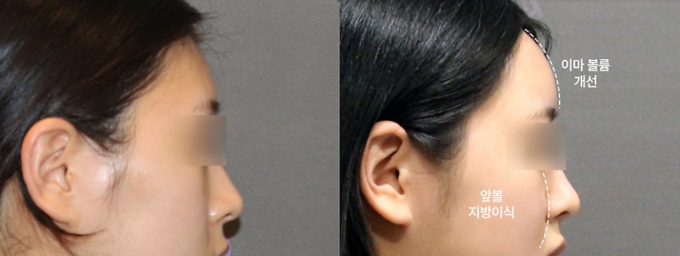 How Can a Sunken Midface Be Corrected? image 4