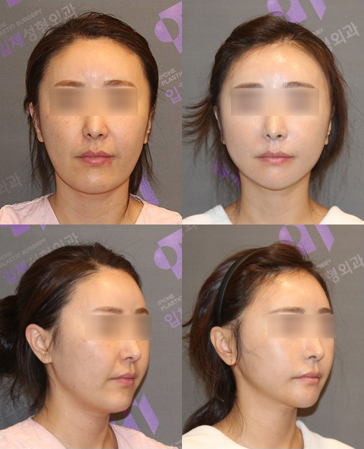 Side Effects That May Occur After Contouring Surgery and the Appropriate Solutions image 6