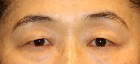 중년눈성형, 눈꺼풀 처짐은 어떻게 해결해야 할까요? 관련 이미지 7