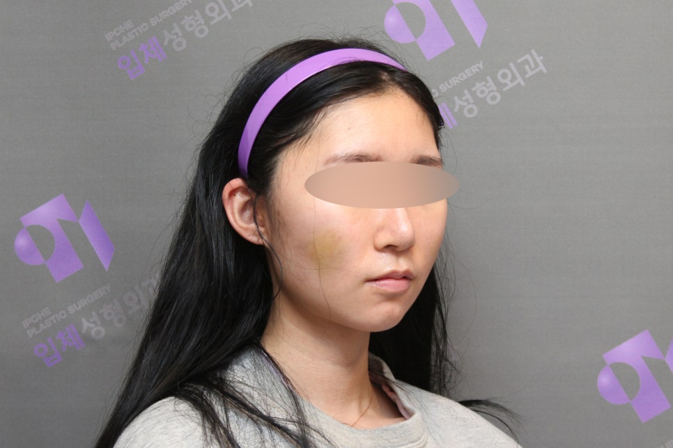 45-Degree Cheekbone Reduction Surgery Review, Let’s Look at Cases Together - Information from a Specialist image 4