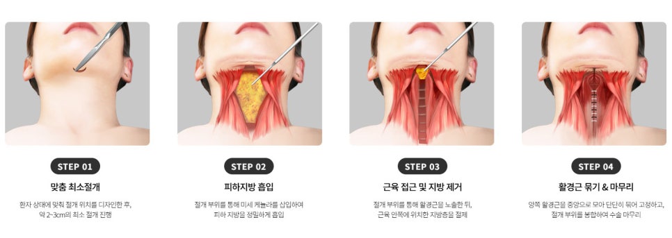 이중턱 수술 단계별 정리 - 지방흡입부터 이중턱 근육묶기까지 관련 이미지 5