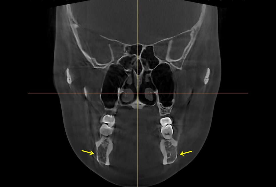 Square Jaw Surgery: The Difference Between Cortical Osteotomy and Lateral Cortical Shaving image 5