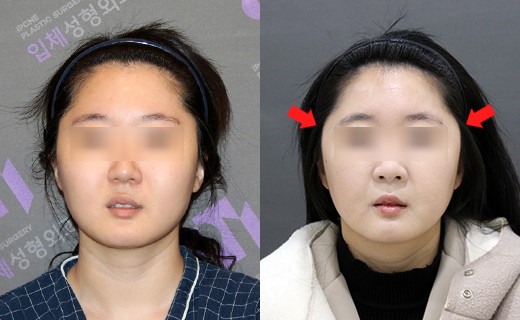 230도입체광대가 3D광대축소술보다 더 좋은가요? 관련 이미지 5