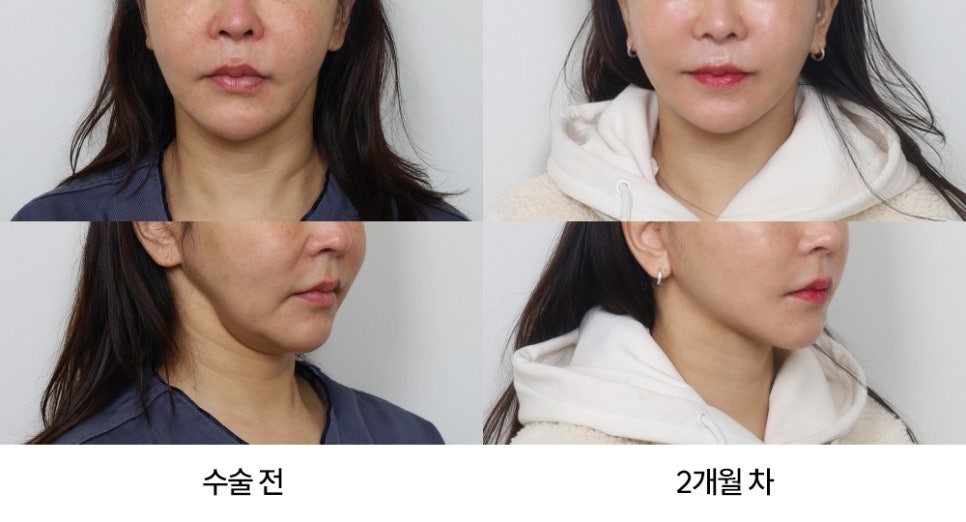 안면거상 수술의 적절한 시기: 얻는 것과 감수해야 할 것 관련 이미지 3
