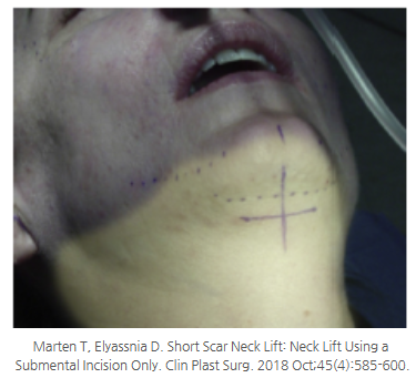 The 4-Step Secret of Double Chin Soft Contouring (Submental Lift): From Incision to Muscle Tightening image 2
