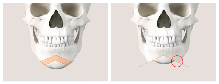 Is There a Way to Address the Secondary Angle That Appears After Chin Surgery? image 4